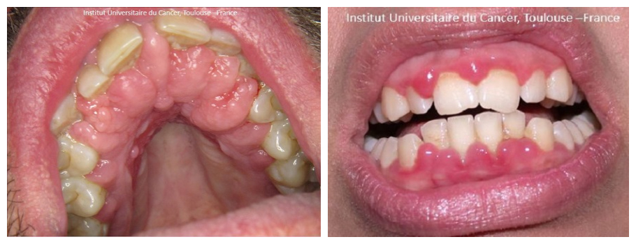 口腔黏膜疾病不简单,看看都有那些病症